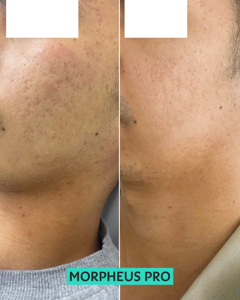 morpheus before and after