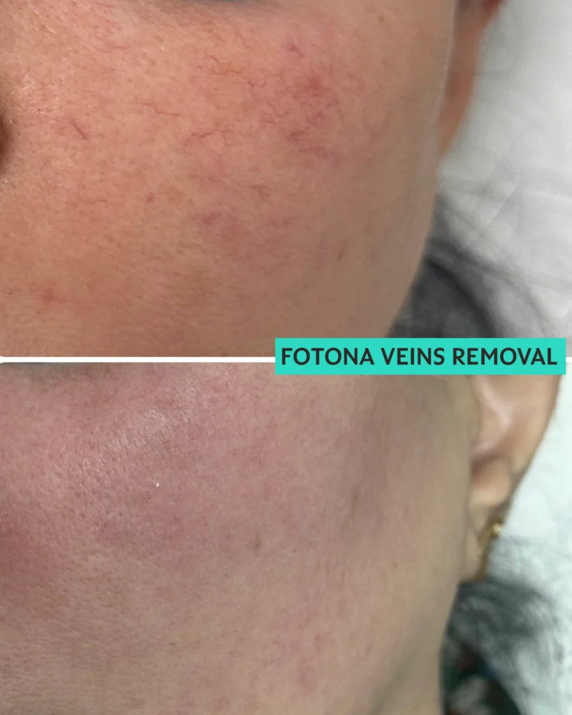 VEIN REMOVAL