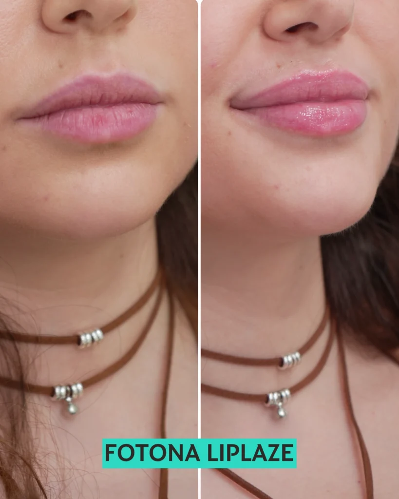 FOTONA LIPLAZE 1