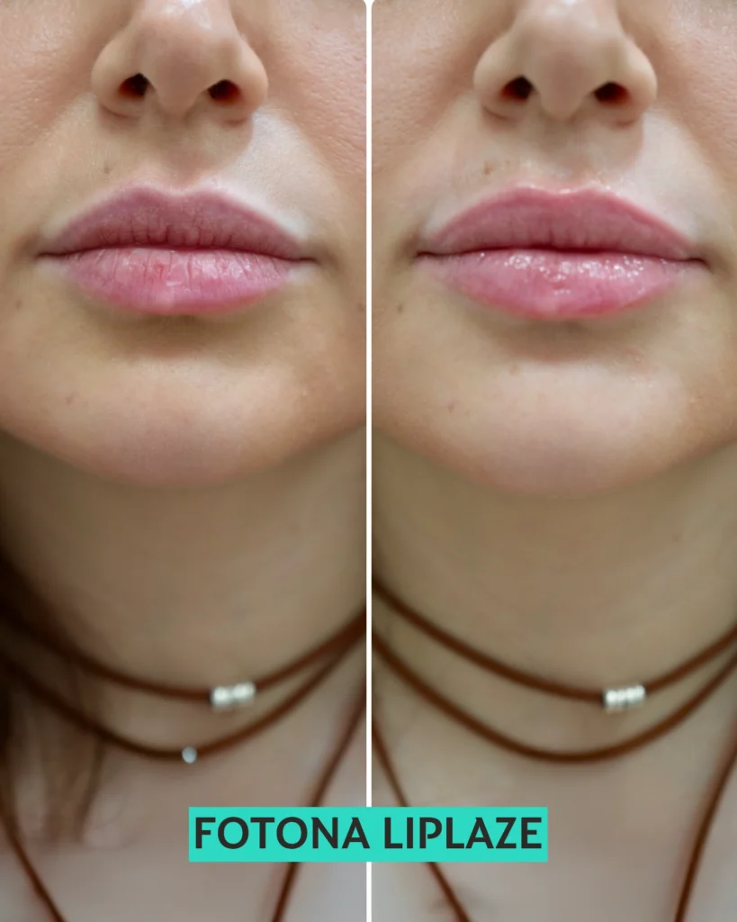 FOTONA LIPLAZE 2