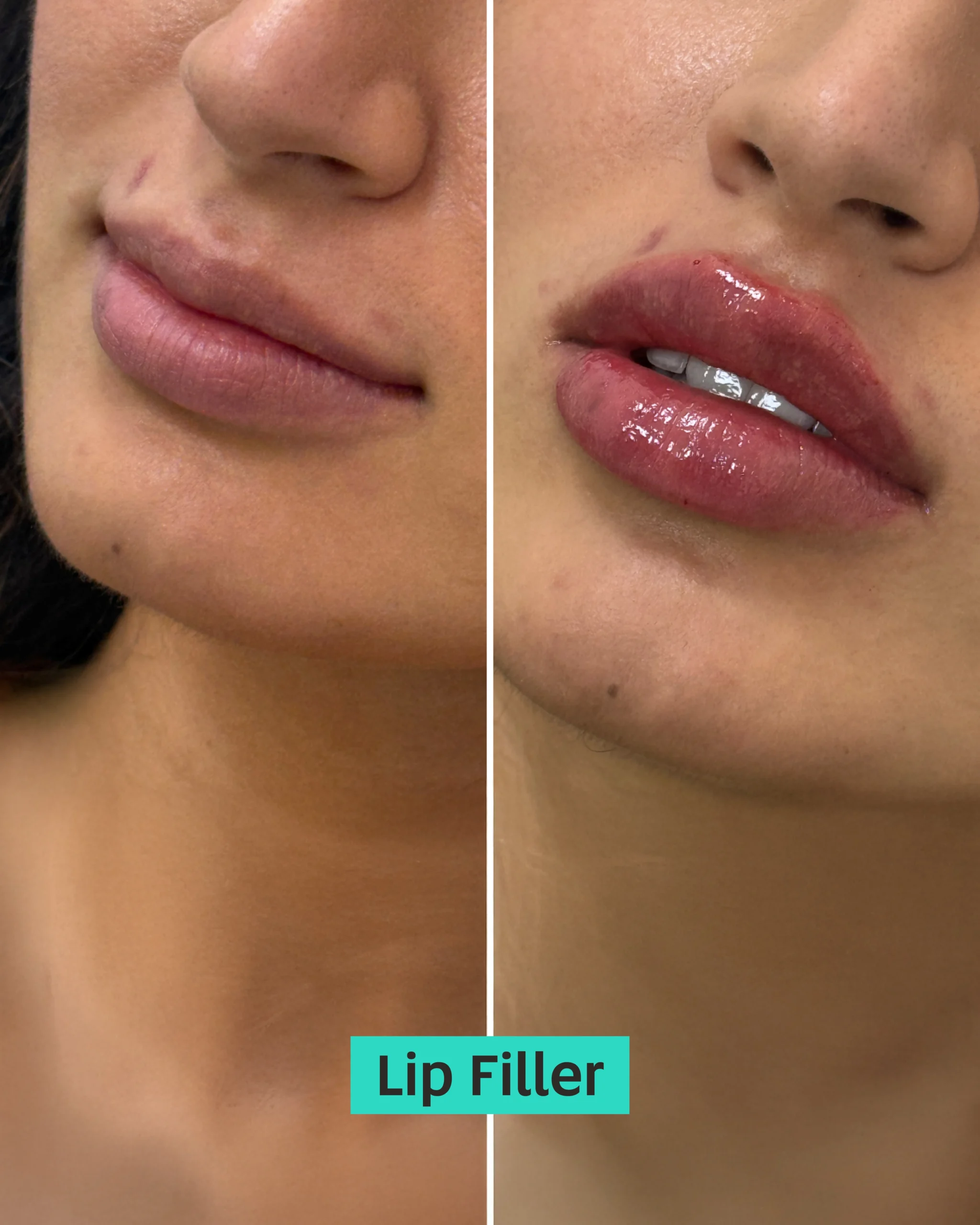 Lip Filler