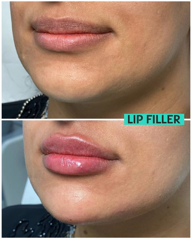 Lip Filler