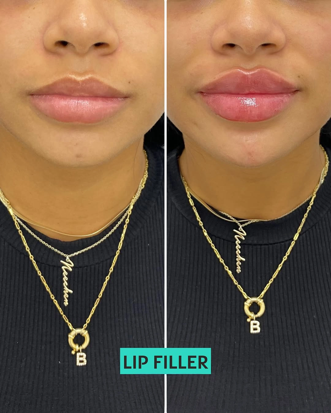 Lip Filler