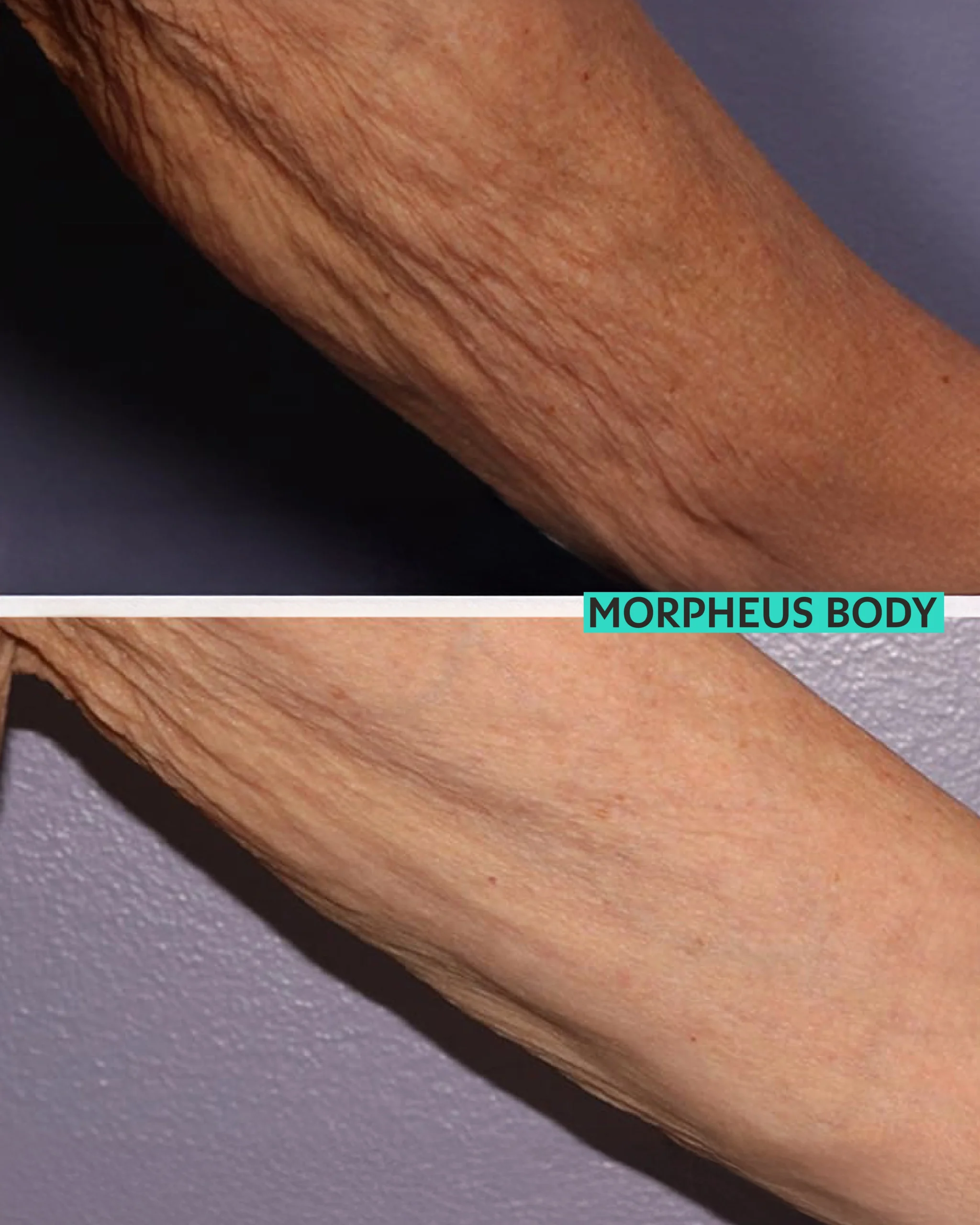 MORPHEUS-05