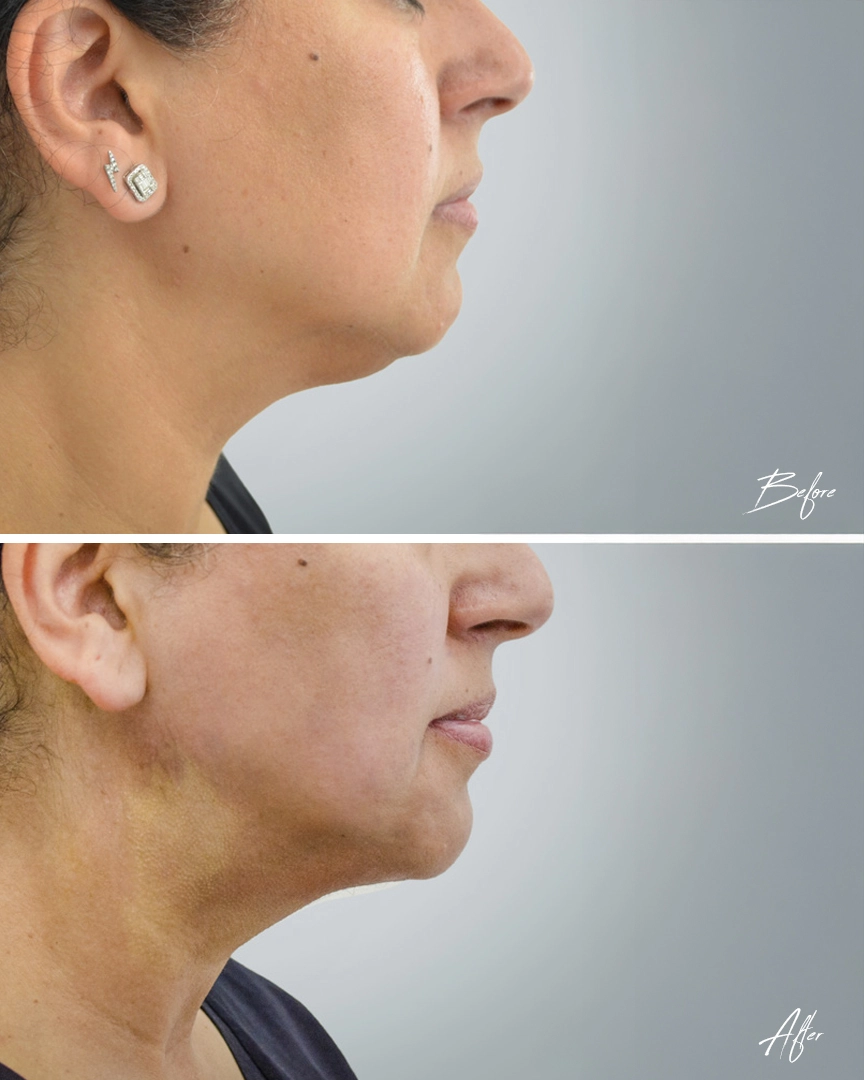 Endolift