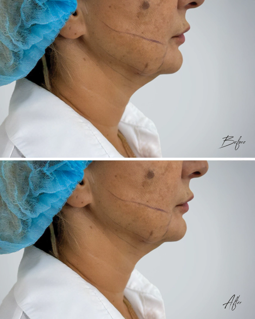 Endolift