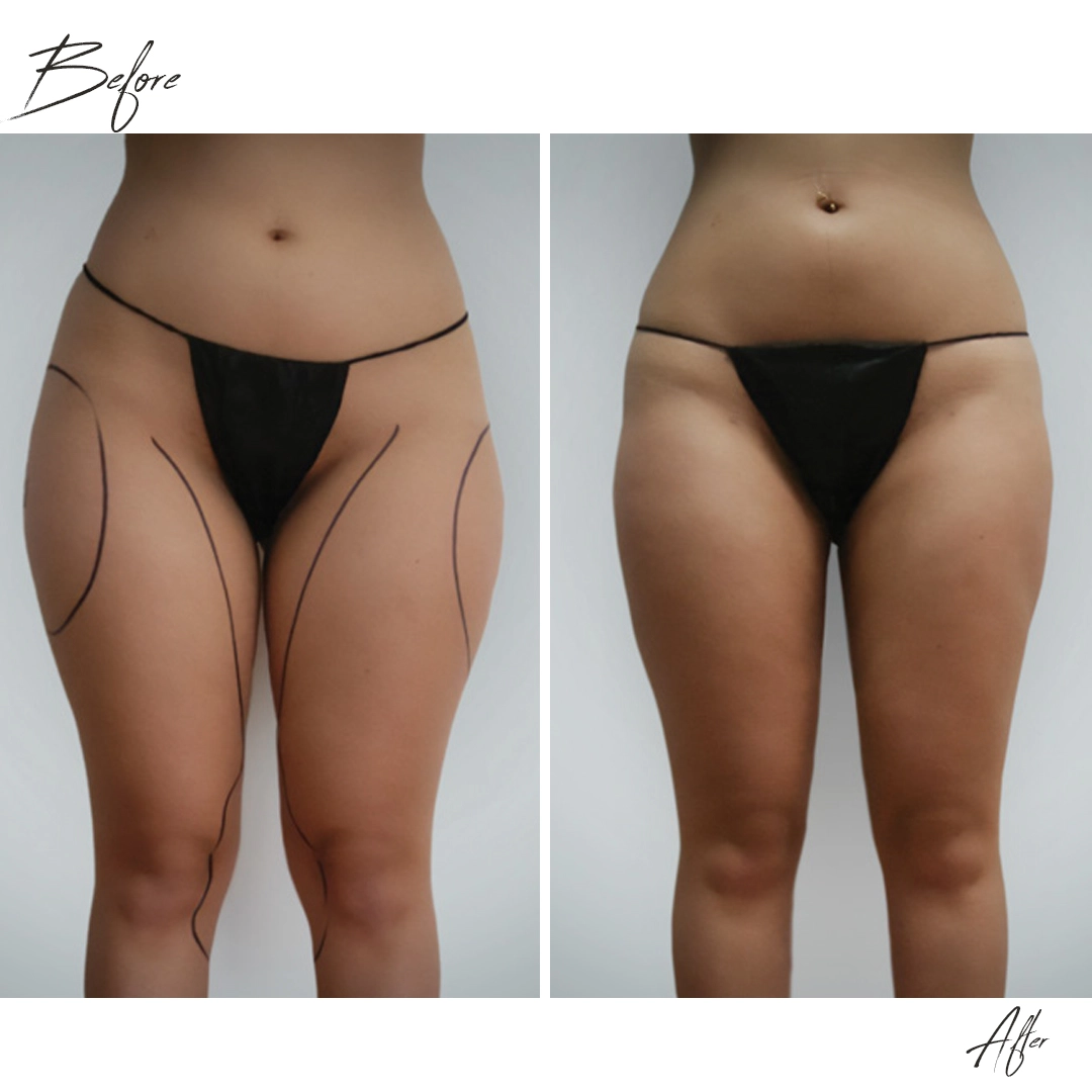 Endolift