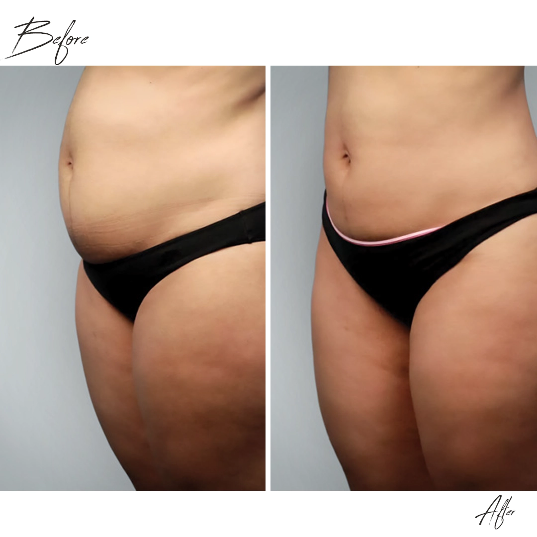 Endolift