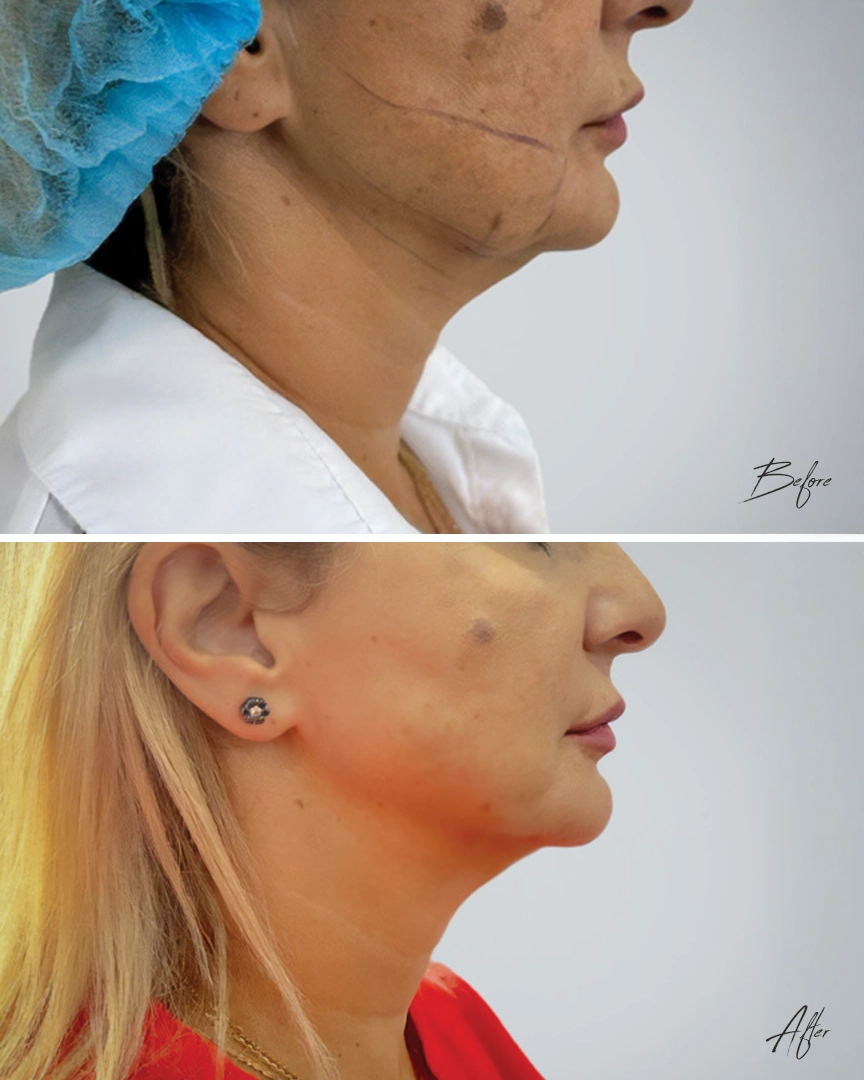 Endolift dubai